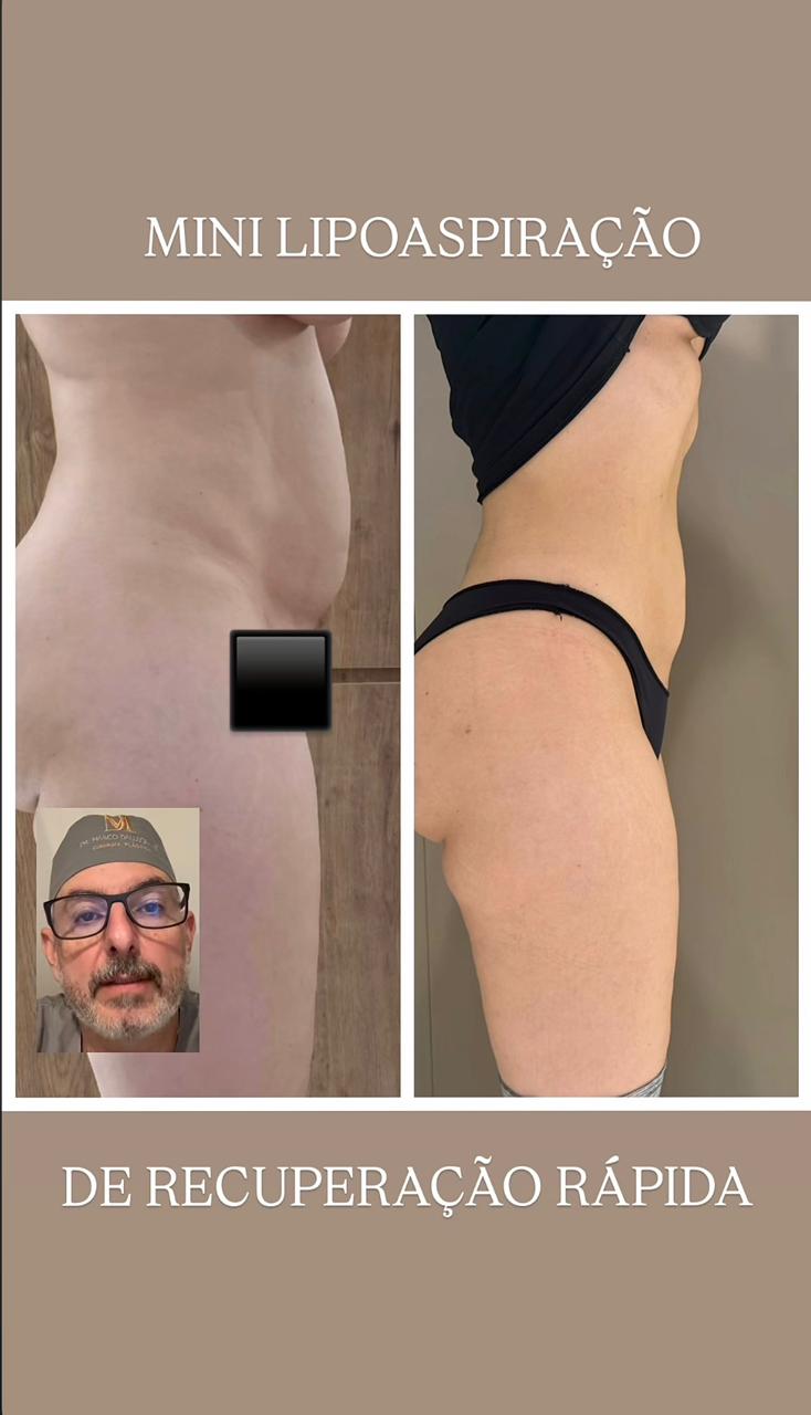 Resultado Mini Lipo